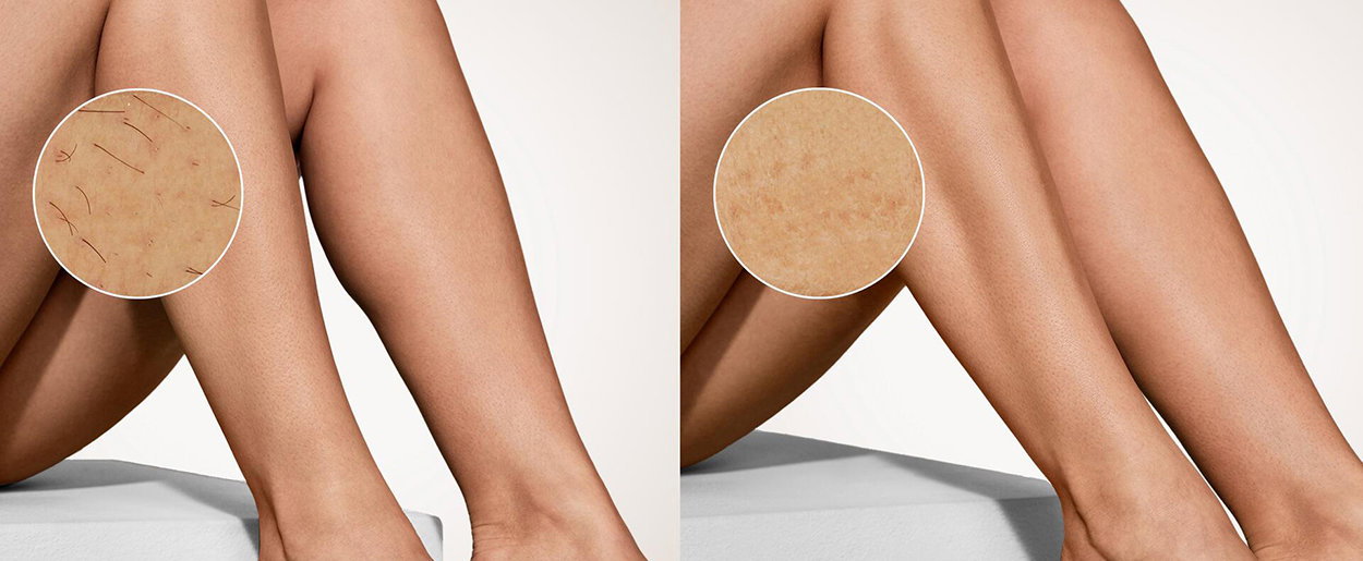 Philips Lumea IPL 9900 Pro BRC344/00 IPL epilátor