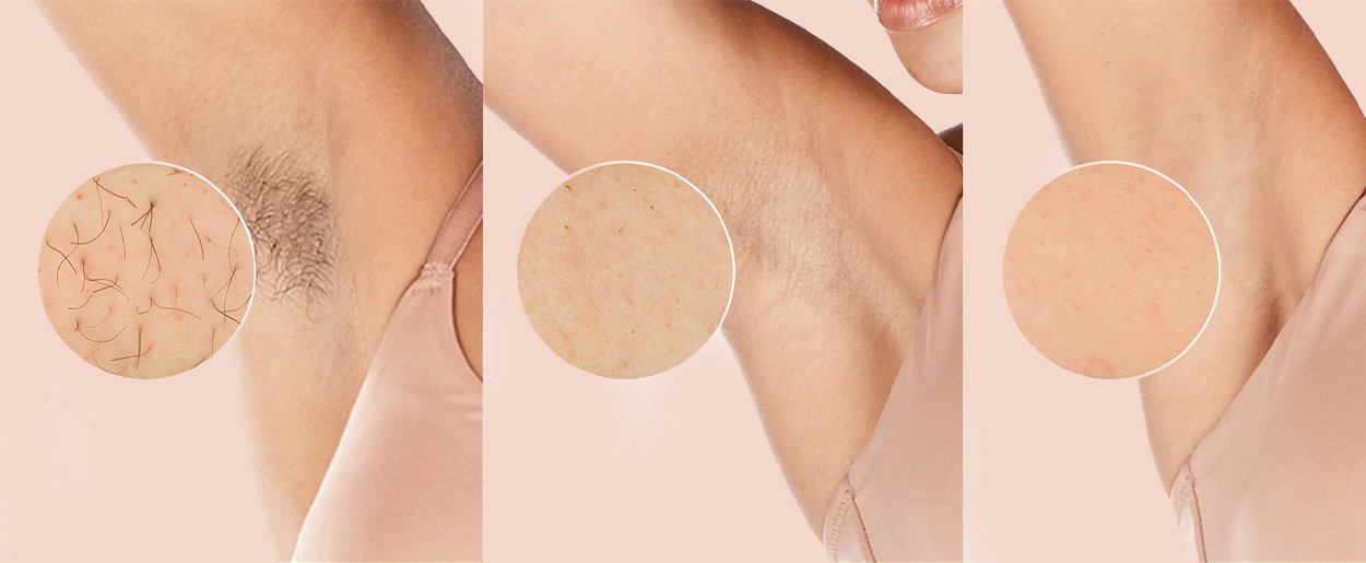IPL epilátor Philips Lumea IPL 9900 BRI950/01