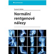 Normal X-ray findings - Torsten B. Möller