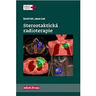 Stereotaktická radioterapie - David Feltl; Jakub Cvek