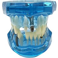 Verk 01964 Model of dental implants, blue - Anatomy Model
