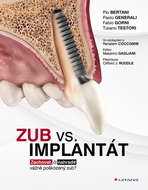 Zub vs. implantát: Zachovat, či nahradit vážně poškozený zub? - Kniha